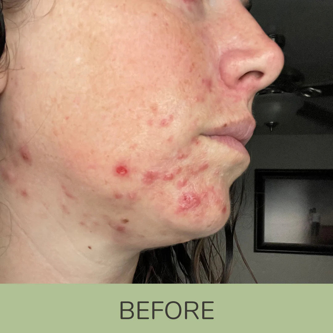 4 Step Clear Skin Routine